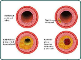 cholesterol