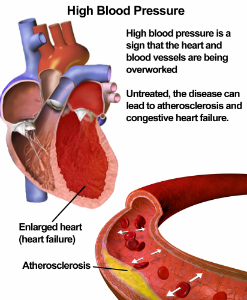 highblood pressure