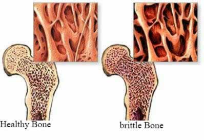 brittle bone