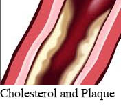 niacin and plaque cholesterol