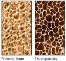 osteoporosis bone